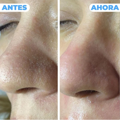 Limpiador de Puntos Negros PureSkin Pro™