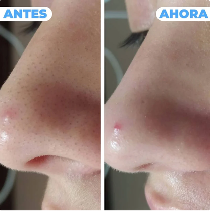 Limpiador de Puntos Negros PureSkin Pro™