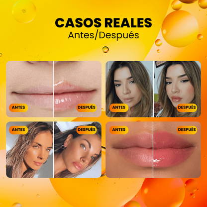 1+1 GRATIS | Voluminizador de Labios con Vitamina E - Derol™ Kit